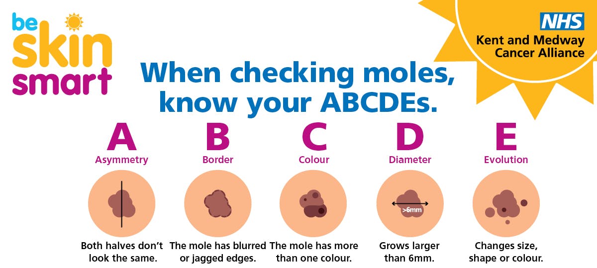 Poster showing five changes to moles to look out for.